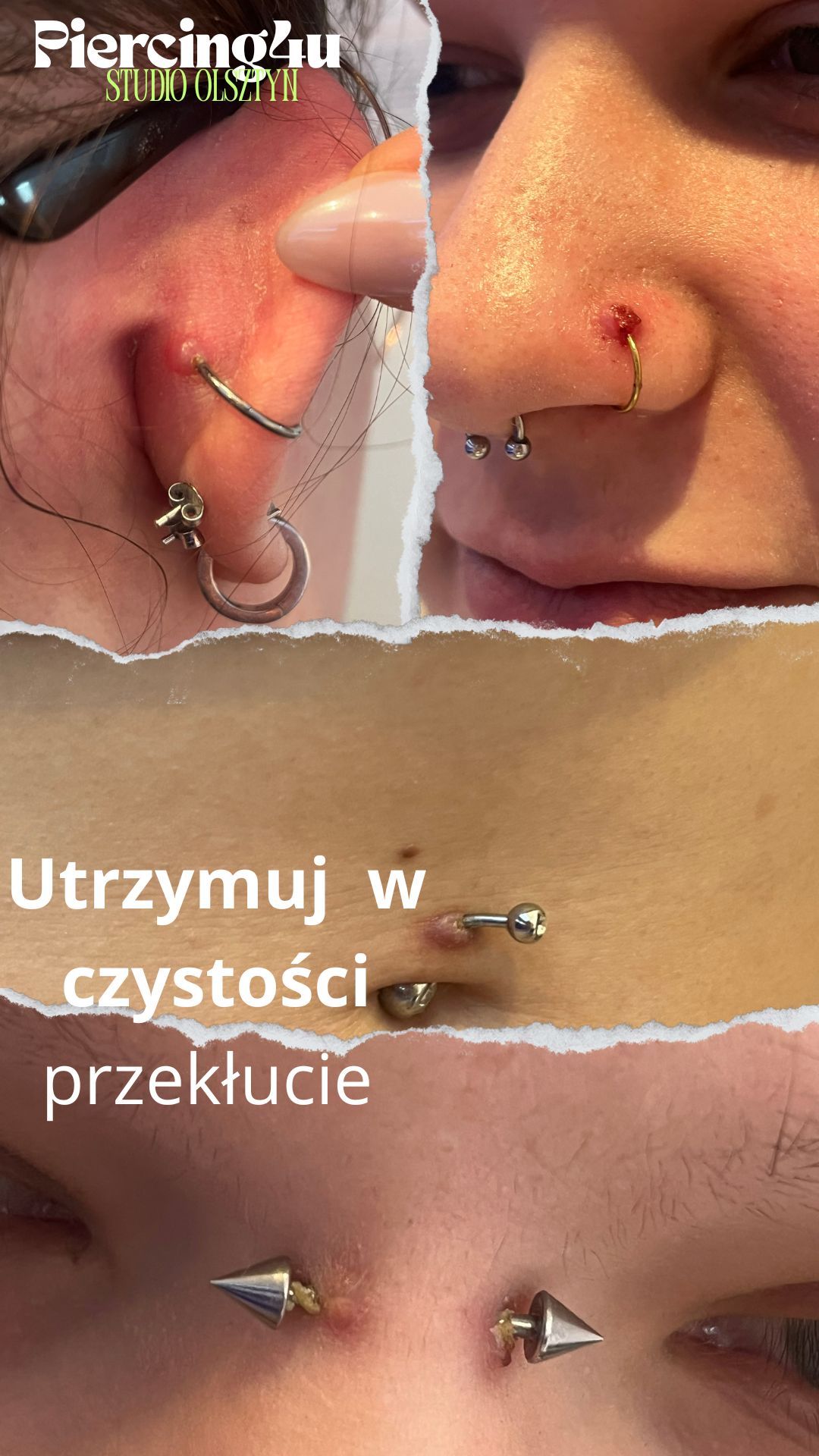 piercing ziarnina  jak leczyć
