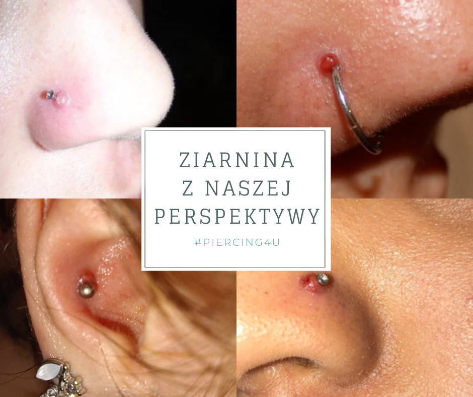 piercing ziarnina  jak leczyc bąbel kolczyk